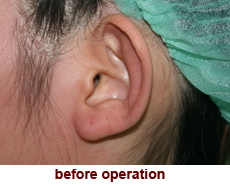 plastic-surgery-prominent-ear 